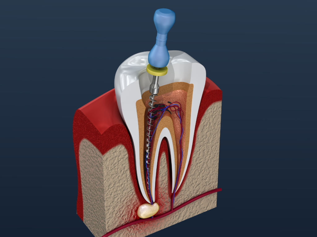 Root Canal Treatment in AS Rao Nagar